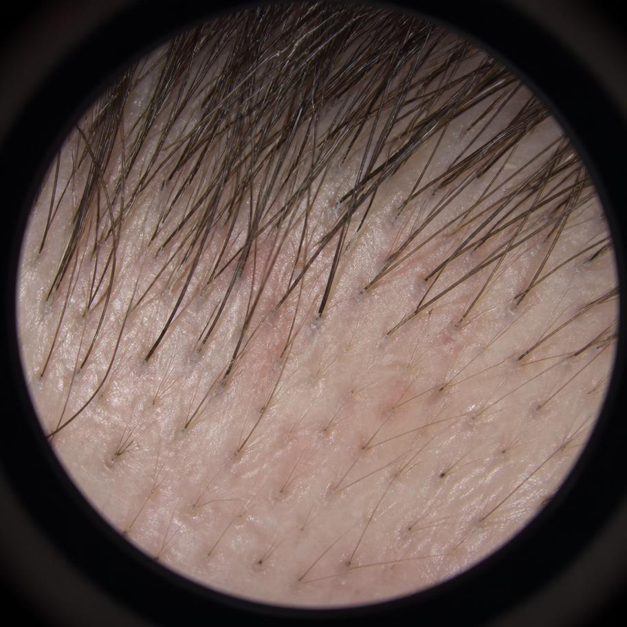 Magnified clinical scalp imaging of the hairline showing follicular openings and hair shafts