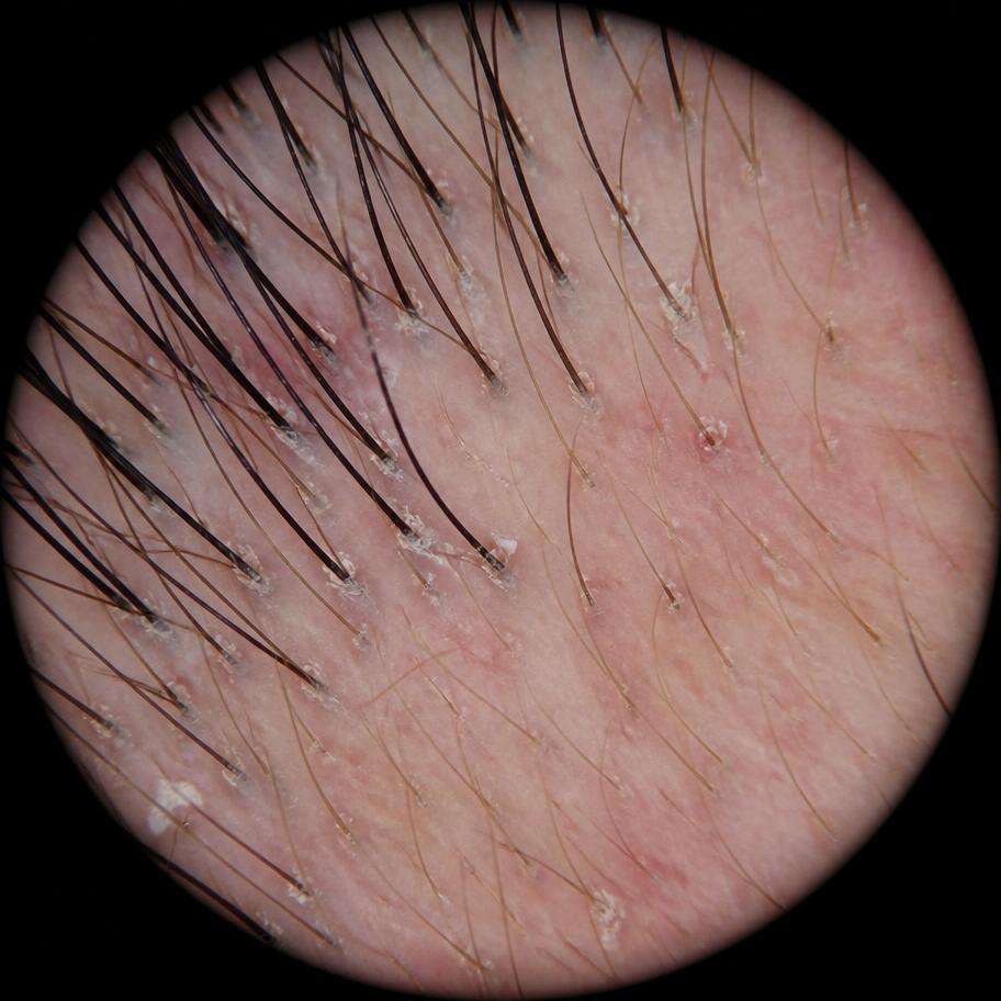Magnified clinical scalp imaging of the temporal area showing scalp surface texture and mild scaling
