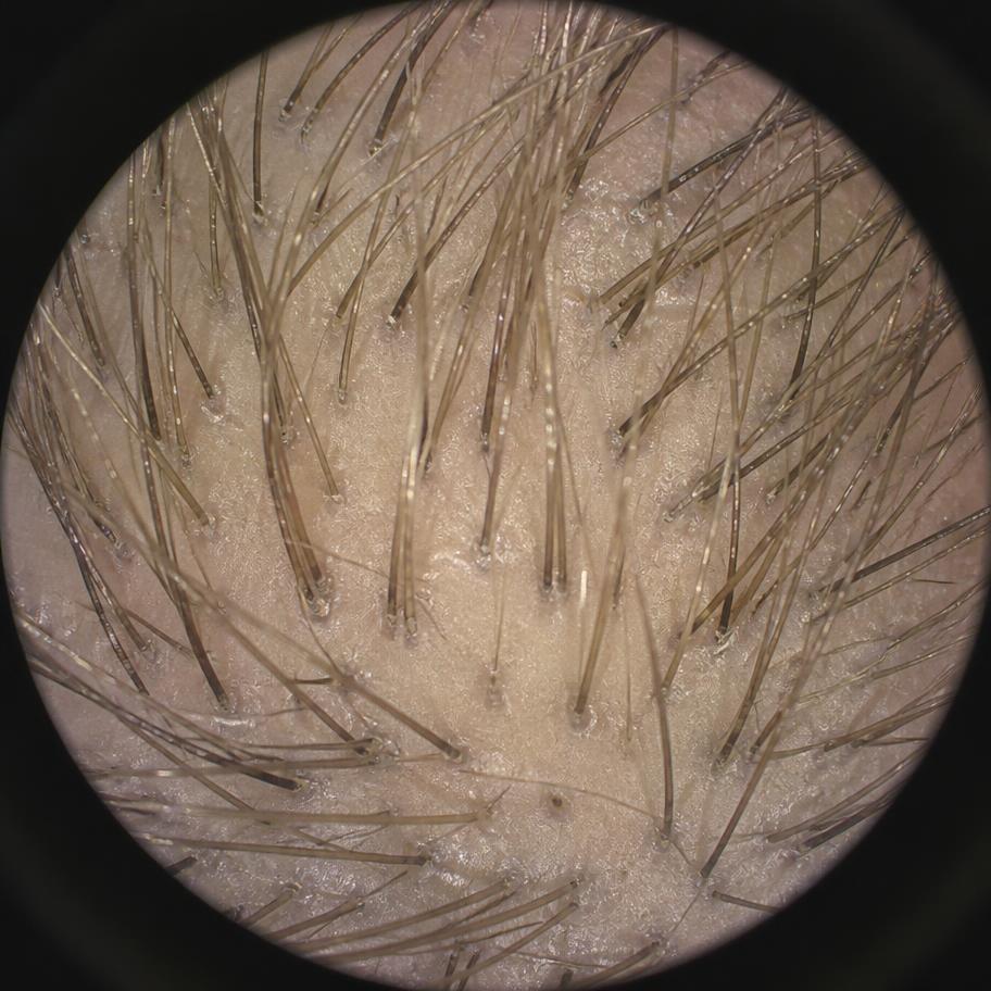 Magnified clinical scalp imaging of the crown showing hair density and variation in strand thickness